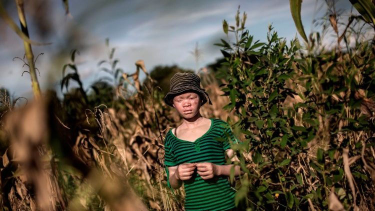 Mara nyingi wenye Ualbino wanapata shida kubwa ya kubaguliwa