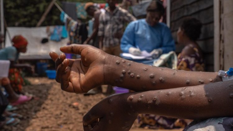 Gli effetti dell'infezione monkey pox nella regione del Kivu hanno provocato oltre 500 morti