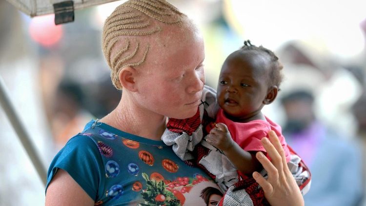 Siku ya Uelewa na Ualbino duniani