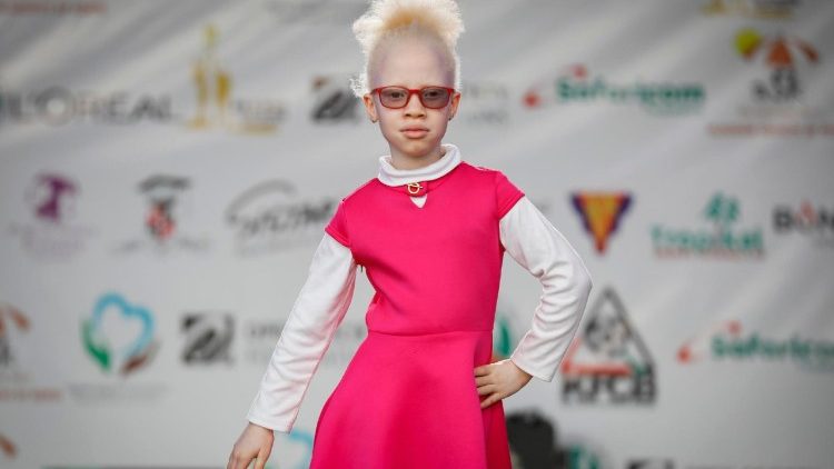 Siku ya Kimataifa ya Uhamasishaji wa Ulewa wa Ulemavu wa Ngozi tarehe 13 Juni