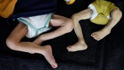 Crianças palestinas que sofrem de desnutrição recebem tratamento em um centro de saúde, em meio à fome generalizada.