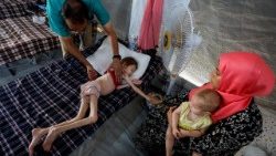 Un copil palestinian subnutrit primește tratament la un spital de campanie în Deir Al Balah, în regiunea centrală a Fâșiei Gaza